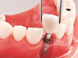 沈阳二氧化锆​全瓷牙的使用期是多少呢?